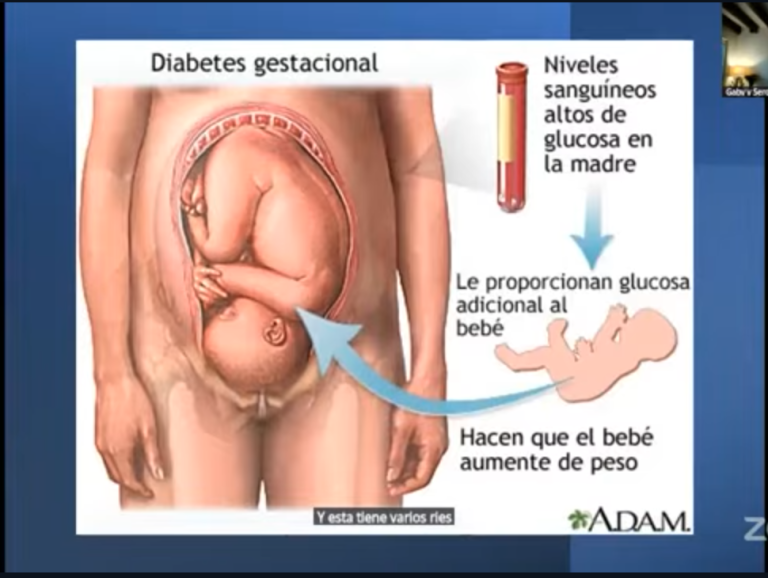 Tipos de diabetes2-diabetes gestacional